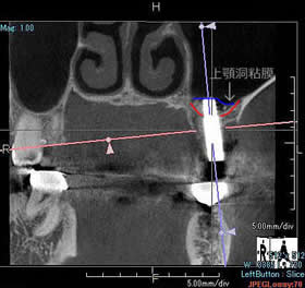 ソケットリフト④