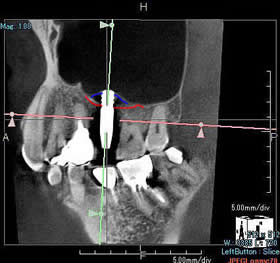 ソケットリフト⑤