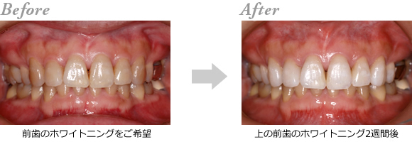 �z���C�g�j���O1