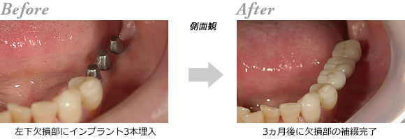 �C���v�����g3