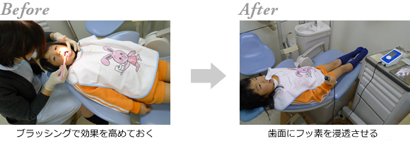 フッ素イオン導入処置中