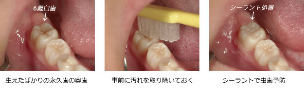 シーラント術式